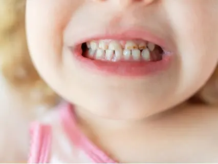 Reasons a Child Needs a Pediatric Root Canal - Kid Grins Will Explain in Detail Reasons a Child Needs a Pediatric Root Canal - Kid Grins Will Explain in Detail