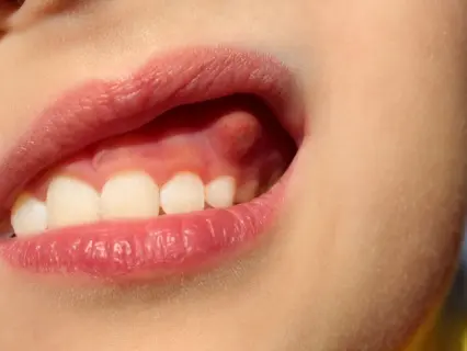 Signs Your Child May Need Pediatric Root Canal Treatment - Kid Grins Can Help Signs Your Child May Need Pediatric Root Canal Treatment - Kid Grins Can Help