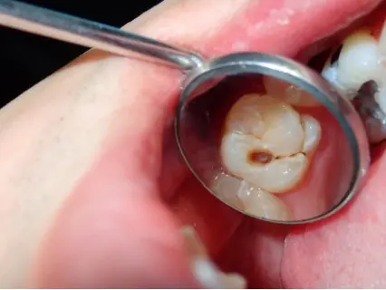 The White Composite Filling Treatment - Kid Grins Shows Step by Step